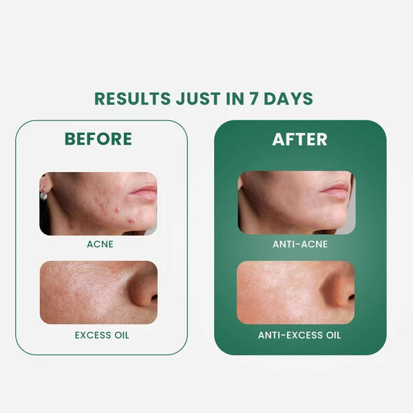 Acne Control In Just 7 Days